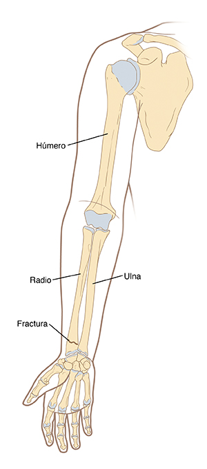 Ilustración que muestra el contorno y los huesos del brazo, incluidos el húmero y el cúbito, y una fractura en el radio.