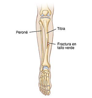 Vista frontal de los huesos de una pierna y de un pie donde se observa una fractura en tallo verde de la tibia.