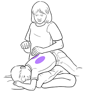 Child lying face down with head lower than hips, supported by pillows. Purple ovals show where to clap for CPT.