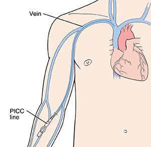 Front view of chest showing PICC line inserted into arm vein.