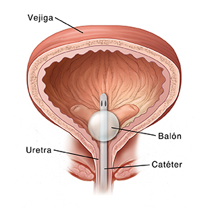 Corte transversal de una vejiga donde puede verse un catéter colocado.
