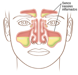 Ilustración del rostro que muestra los senos paranasales inflamados.
