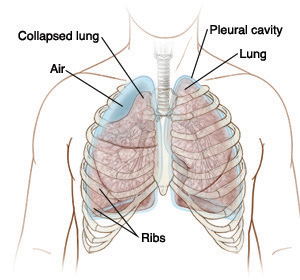 Chest, showing position of the collapsed lung, air pockets, healthy lung, ribs, and pleural cavity.