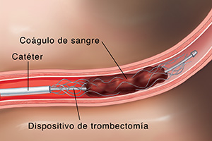 Seccion transversal de la arteria en el cerebro que muestra el catéter y el dispositivo insertados en el trombo.