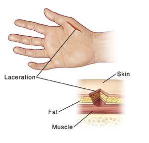 Hand with laceration, with detail of laceration that shows cross section of fat, skin, and muscle.