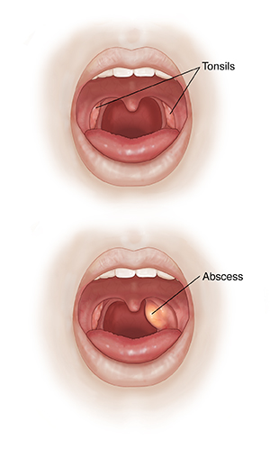 Two images of open mouth showing normal oral cavity and peritonsillar abscess.