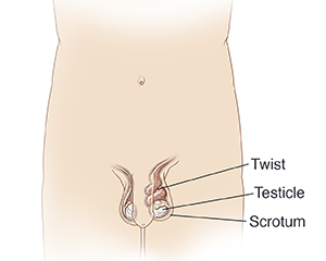 Front view of male pelvic area showing testicular torsion.