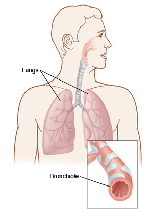 Front view of chest, showing the lungs and a closeup view of a bronchiole, a small airway that can get inflamed and restrict the flow of air.