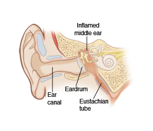 Cross section of ear, ear canal, eardrum, inflamed middle ear, and eustachian tube.
