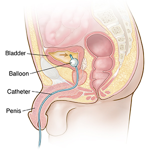 Cross section of male pelvis showing foley catheter inserted into bladder.
