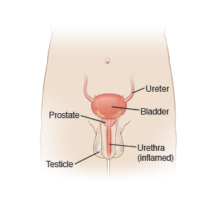 Male urinary tract, showing bladder, ureter, prostate, testicles, and inflamed urethra.