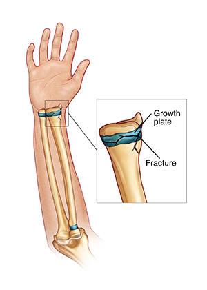 Palm-up view of forearm showing arm bones and a growth plate fracture.