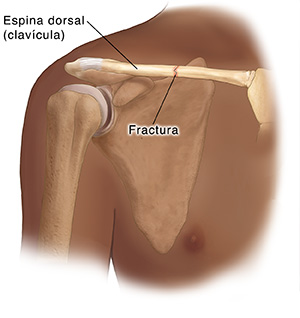 Vista anterior de la articulación del hombro que muestra una fractura en la clavícula.
