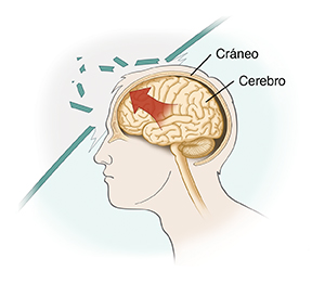 Vista lateral de una cabeza donde se observan lesiones cerebrales.