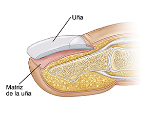 Corte transversal de la punta de un dedo donde se ve una avulsión total de la uña.