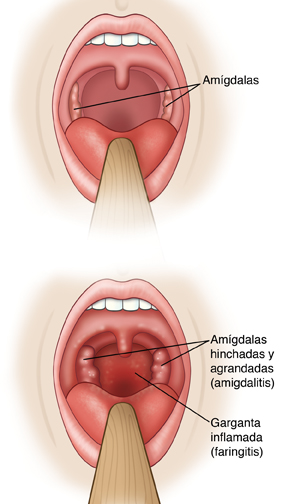 Dos vistas en primer plano de la garganta en donde se observan las amígdalas de tamaño normal, y las amígdalas y la garganta inflamadas.