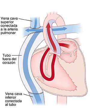 Corte transversal visto de frente de un corazón en donde se muestra el procedimiento de Fontan para tratar un ventrículo izquierdo hipoplásico. La vena cava superior está conectada a la arteria pulmonar. Un tubo por fuera del corazón se conecta a la vena cava inferior en la base y a la vena cava superior en la parte superior. Unas flechas muestran que la sangre fluye de la aurícula izquierda al ventrículo derecho, y, luego, se bombea hacia afuera de la aorta.