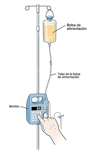 Bolsa de alimentación que cuelga de un soporte de la bomba. Un dedo presiona el botón de encendido.