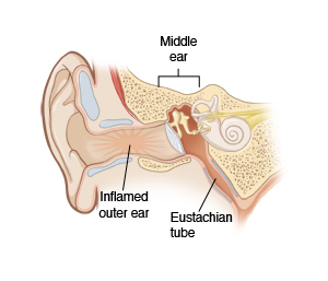Image showing a cross-section of the ear, including the middle ear, inflamed outer ear, and eustachian tube.