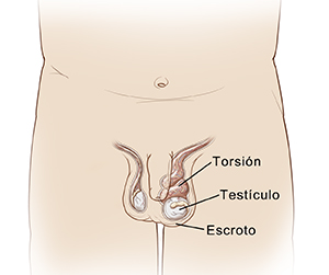 Vista frontal del área pélvica de un niño en la que se ve una torsión testicular.