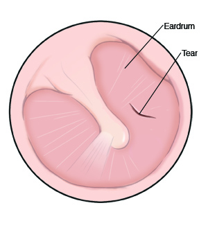 Eardrum with a tear.