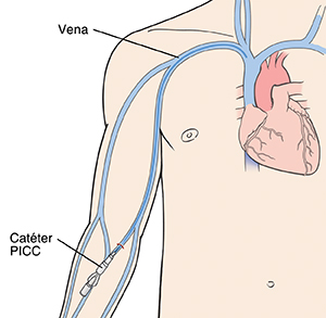 Vista frontal del tórax donde se observa el catéter central de inserción periférica (PICC, por su sigla en inglés) colocado en la vena del brazo y cuya punta termina cerca del corazón.