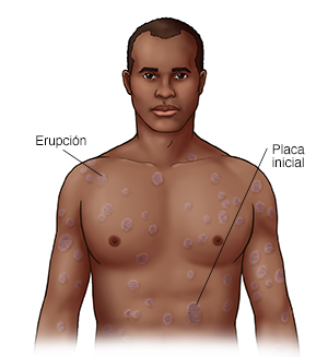 Vista frontal de la cabeza y el pecho de un hombre donde puede verse pitiriasis rosada.