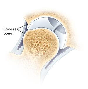 Cross section of hip joint showing abnormal bump of excess bone on ball of thighbone and on lip of socket.
