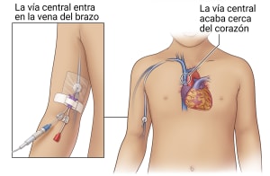 El PICC colocado en el brazo justo por encima del codo se conecta a las venas cercanas al corazón.