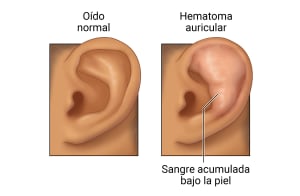 Oído externo normal en comparación con el oído con piel hinchada y roja en la mitad superior del oído.
