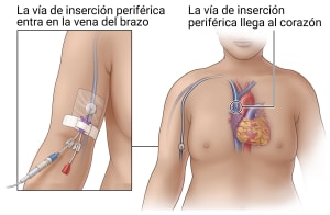 El PICC colocado en el brazo justo por encima del codo se conecta a las venas cercanas al corazón.