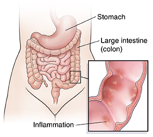 Front view of female outline showing digestive system. Inset shows cross section of colon with Crohn's disease.