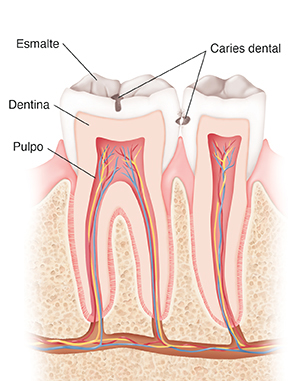 Corte entre dos dientes, encías y huesos que muestra las caries.