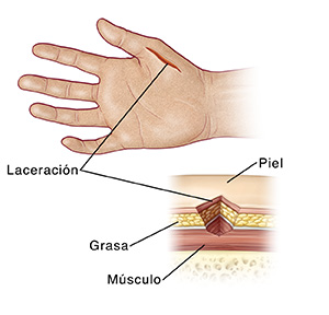 Imagen de una mano con una laceración y primer plano de corte transversal de la laceración donde pueden verse el tejido adiposo, la piel y el músculo.