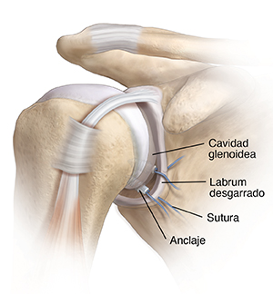 Articulación del hombro que muestra la cavidad glenoidea, el labrum desgarrado y una sutura de anclaje