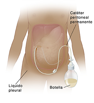 Vista anterior del torso femenino con el abdomen extendido que muestra el catéter unido a la botella de drenaje e insertado bajo la piel y en el peritoneo.