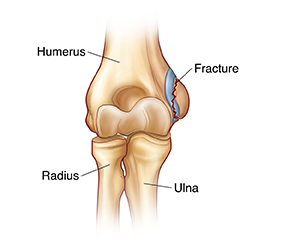 Front view of elbow joint with fracture.