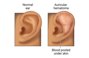 Normal external ear compared to ear with puffy, red skin in the top half of the ear.