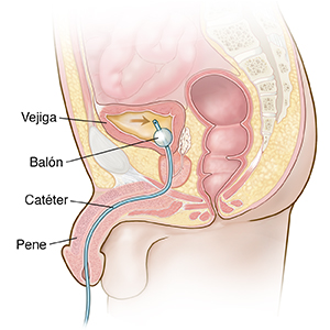 Sección transversal de la pelvis masculina que muestra la sonda de Foley insertada en la vejiga.