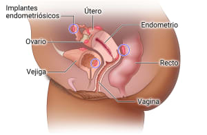 Los implantes endometriales pueden encontrarse fuera del endometrio, incluyendo el útero, las trompas de falopio, los ovarios, la vejiga y el recto.