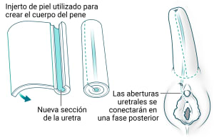 Se utiliza un injerto de piel para crear el cuerpo del pene con una nueva sección de la uretra. El cuerpo se une por encima del clítoris existente. Las aberturas de la uretra se conectarán en una fase posterior.
