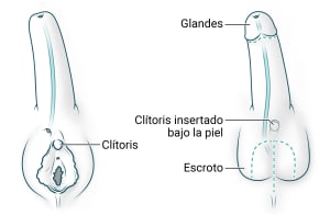 La nueva uretra, más larga, se conecta al cuerpo del pene. Se crea el glande con la abertura uretral en la parte superior. El clítoris existente se inserta bajo la piel y se crea el escroto.