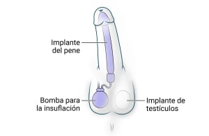 El implante del pene se inserta en el cuerpo del pene. También se añade al escroto el implante de testículos y una bomba para la insuflación 