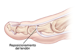 Vista lateral de un dedo del pie donde se observa la transferencia del tendón flexor.