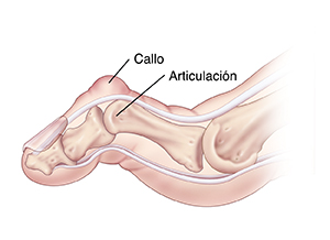 Vista lateral de un dedo del pie donde se observan un callo y un dedo de martillo rígido.