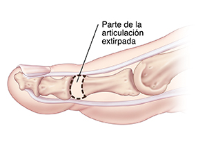 Vista lateral de un dedo del pie donde se observa el hueso extirpado para la artroplastia.