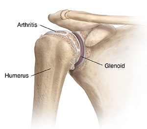 Front of shoulder joint, showing arthritis between glenoid and ball of humerus.