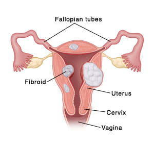 Cross section of uterus showing fibroids, fallopian tubes, cervix, and vagina.