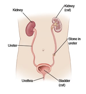 Outline of torso showing front view of urinary tract two kidneys in upper abdomen each kidney is connected by ureter to bladder. 