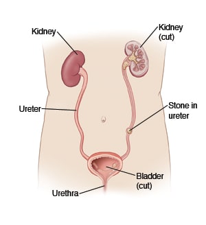 Illustration showing the anatomy of the urinary system, including the kidneys, bladder, urethra, and a stone in the ureter.